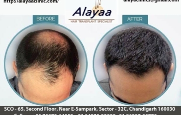 Alayaa Clinic-Best Hair Transplant Specialist in Chandigarh